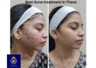 Best Acne Treatment in Thane – Advanced Acne Care at DNA Royal.