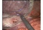 Advanced Gastrointestinal Tumor Treatment by Experienced Specialists 