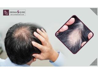 Regain Healthy Hair with Expert Care Through Alopecia Treatment in Bangalore