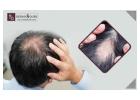 Regain Healthy Hair with Expert Care Through Alopecia Treatment in Bangalore