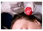 Top benefits of getting PRP Treatment in Dubai