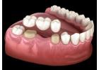 Dental Crown & Bridges in Noida for Smile Restoration