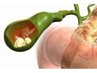 Trusted Expertise from the Best Doctor for Gallbladder Stone Surgery in Kolkata