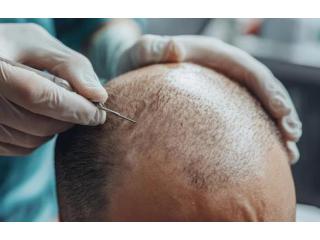 Hair Transplant in Delhi with Affordable Cost | Langersculpt