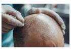 Hair Transplant in Delhi with Affordable Cost | Langersculpt