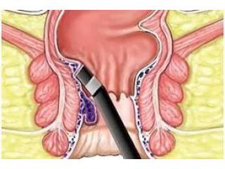 Experienced Fissure Surgeon in Kolkata | Dr. Purnendu Roy