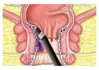 Experienced Fissure Surgeon in Kolkata | Dr. Purnendu Roy