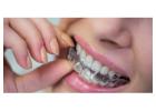 Customized Invisalign Aligners in Ludhiana for Better Oral Health
