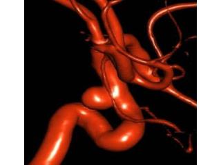 Advanced Neuro Care Through Aneurysm Brain Coiling
