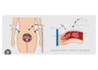 Hernia Surgery Near You