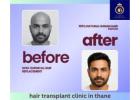 Hair Transplant Clinic in Thane – Expert Hair Restoration at DNA Royal.