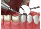  Professional Deep Teeth Cleaning in San Antonio TX | Primo Dental