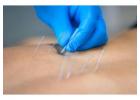 Dry Needling Services for Effective Pain Relief & Muscle Recovery