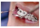 Teeth Extractions in Rosedale, MD | Gentle & Affordable Dental Care
