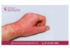 Effective Atopic Dermatitis Treatment in Bangalore by Experts - Dr. Priya Skin and Hair Clinic