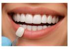 Composite Resin Veneers in Azle TX | Azle Smiles