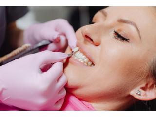 Professional Teeth Whitening Services in Mickleham - Quality Dental Care Mickleham