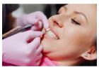 Professional Teeth Whitening Services in Mickleham - Quality Dental Care Mickleham