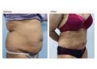 Liposuction Surgery in Delhi - Dr Rajat Gupta 