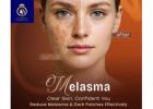 Trusted Clinic for the Best Melasma Treatment in Thane | DNA Royal.