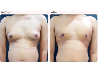 Gynecomastia Surgery Cost in Delhi - Dr Rajat Gupta