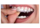 Best Invisalign Cost in Gurgaon