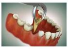 Gentle Tooth Extraction in Rockport TX | Allwyn Dental
