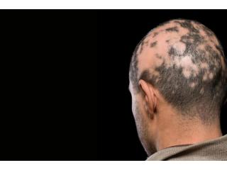 Alopecia Areata Treatment in Delhi – Advanced Hair Regrowth Solutions at Iksana Wellness
