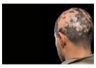 Alopecia Areata Treatment in Delhi – Advanced Hair Regrowth Solutions at Iksana Wellness