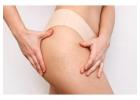 Stretch Mark Reduction Treatment in Delhi – Restore Smoother, Healthier Skin at Iksana Wellness