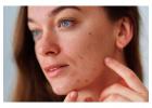 Dermatologist Orlando | Allergy & Asthma Center | Skin check, Acne, Skin Cancer, Moles 