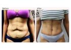 Tummy Tuck Surgery in Delhi - Dr Rajat Gupta