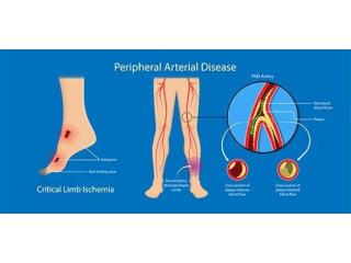 Peripheral Arterial Disease Treatment