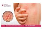 VYour Destination for the Best Allergy Treatment in Bangalore -Dr. Priya Skin and Hair Clinic