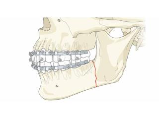 Jaw Surgery in India | Dr. Anurag Bhargava