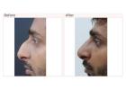 Rhinoplasty Surgery in Delhi - Dr Rajat Gupta