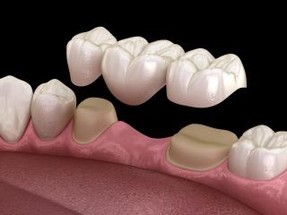 Dental Implants in Abbotsford | Permanent Tooth Replacement