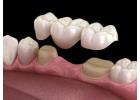 Dental Implants in Abbotsford | Permanent Tooth Replacement