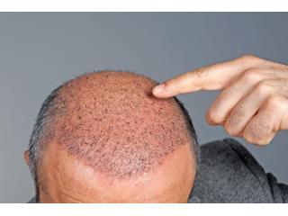 Best Hair Transplant Clinic in Gurgaon For Natural Results