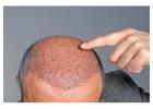 Best Hair Transplant Clinic in Gurgaon For Natural Results