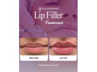 Allodermis Skin Clinic | Advanced Lip Filler Treatment in Delhi