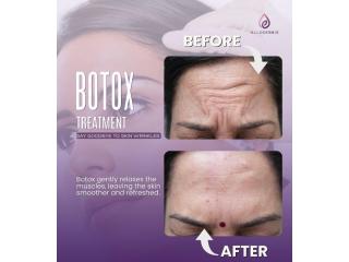 Allodermis Skin Clinic | Advanced Botox Treatment in Jajpur
