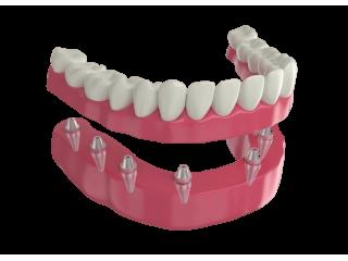 Affordable Implant Secured Dentures in Burton – Burton Advance Dental
