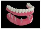 Affordable Implant Secured Dentures in Burton – Burton Advance Dental