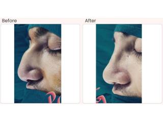 Nose surgery cost in Delhi - Dr Rajat Gupta