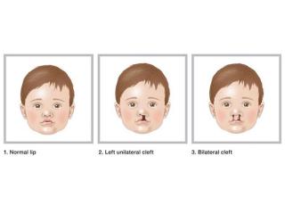 Cleft Lip and Palate in India | Dr. Anurag Bhargava
