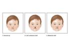 Cleft Lip and Palate in India | Dr. Anurag Bhargava