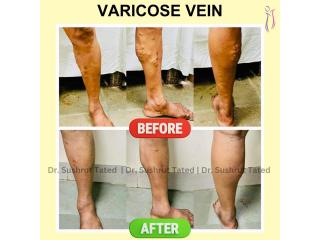 Varicose veins surgery in Baner - The Aesthetic Hub