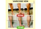 Varicose veins surgery in Baner - The Aesthetic Hub