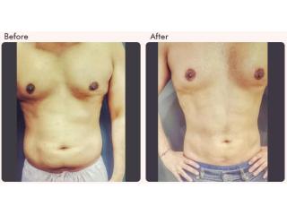 Liposuction Surgeon in Delhi - Dr Rajat Gupta